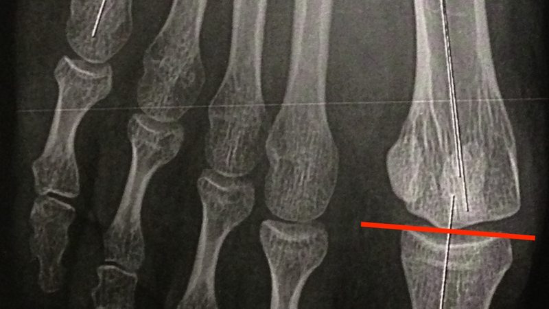 防爆轮胎与普通轮胎：如何根据需求精准选择